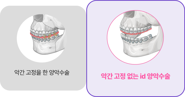 삼악수술 이미지