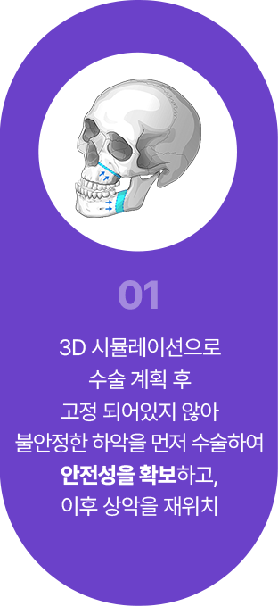 01 3d시뮬레이션으로 수술 계획 후 고정 되어있지 않아 불안정한 하악을 먼저 수술하여 안정성을 확보 하고, 이후 상악을 재위치
