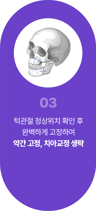 03 턱관절 정상위치 확인 후 완벽하게 고정하여 악간고정 치아교정 생략