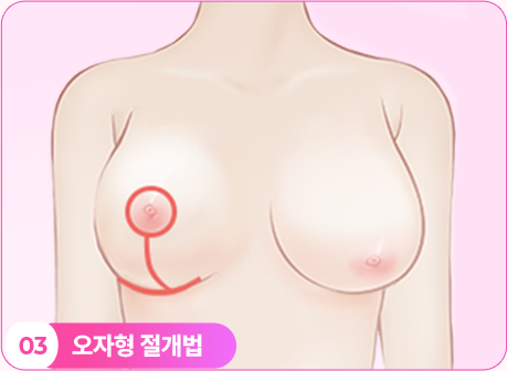 오자형 절개법